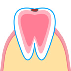 エナメル質の虫歯のイラスト