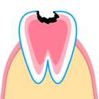 象牙質の虫歯のイラスト