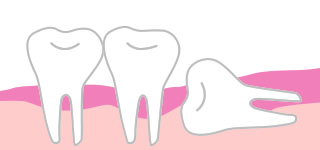 埋伏智歯（親知らず）抜歯の写真・イラスト