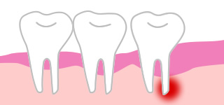 歯根端切除術＋嚢胞摘出術の写真・イラスト